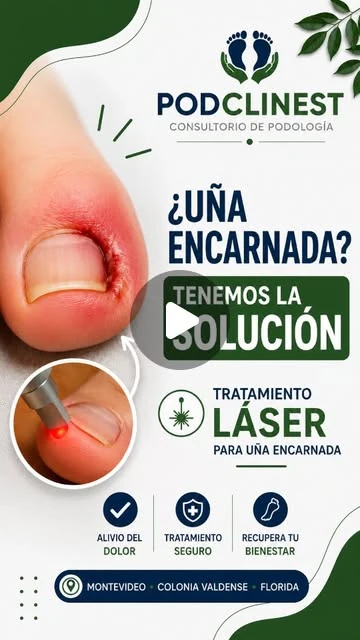 Miniatura de Instagram sobre uña encarnada