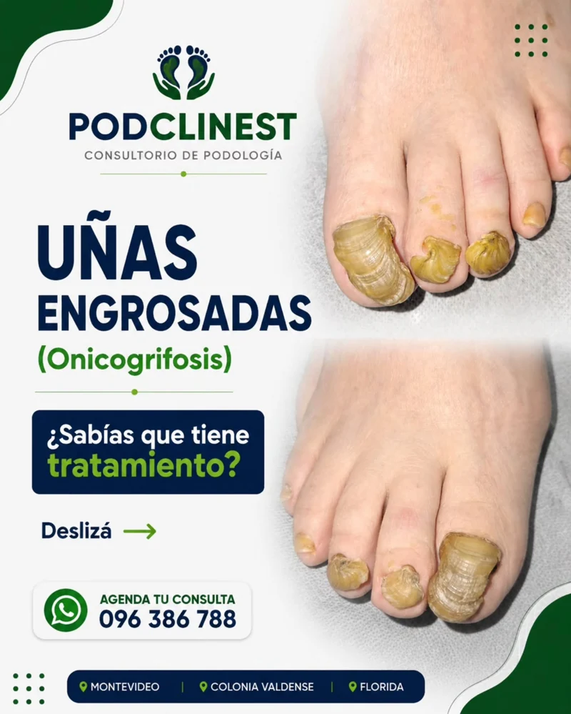 Miniatura de Instagram sobre uñas engrosadas