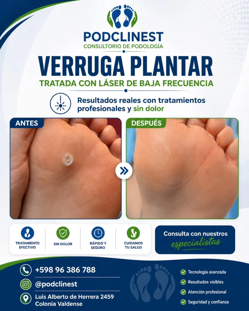 Miniatura de Instagram sobre verruga plantar